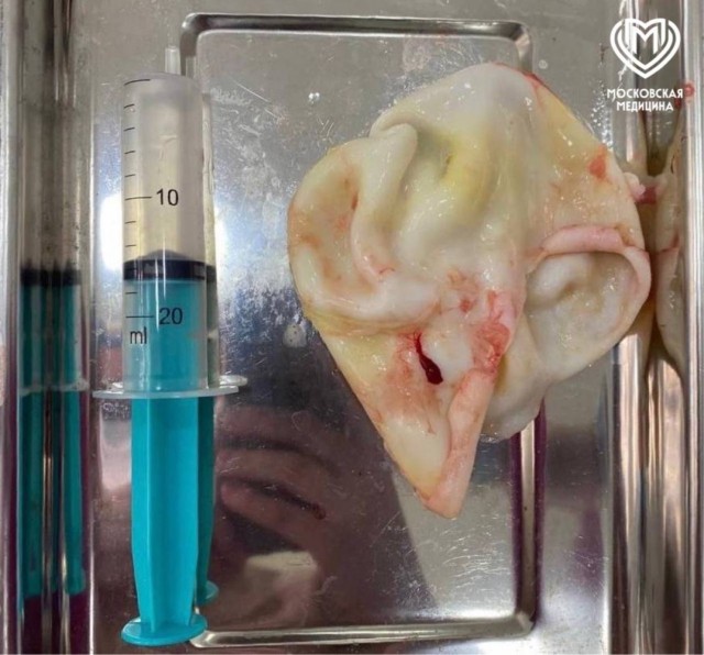 Паразит-мутант размером с яблоко поселился в лёгком