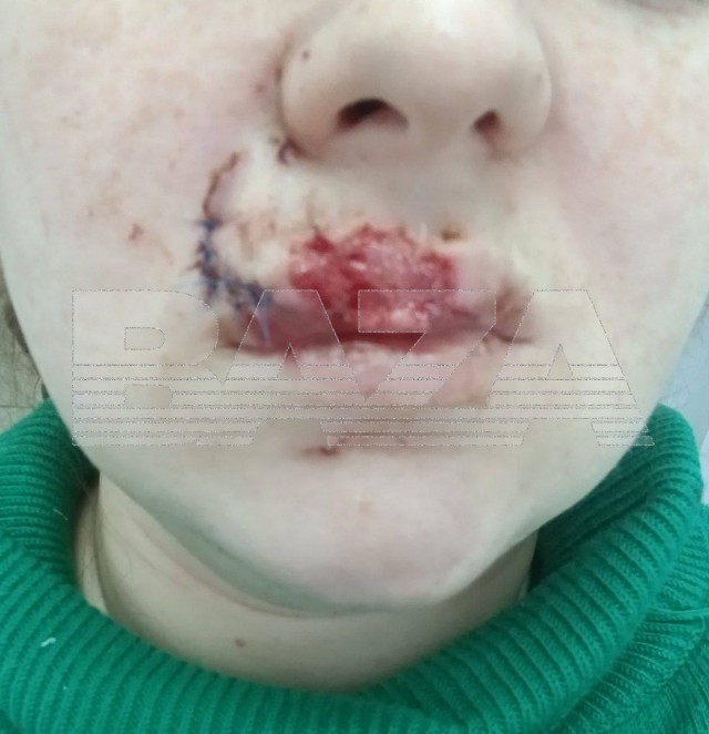 Молодая мама осталась без верхней губы после нападения бродячего пса в Саратове