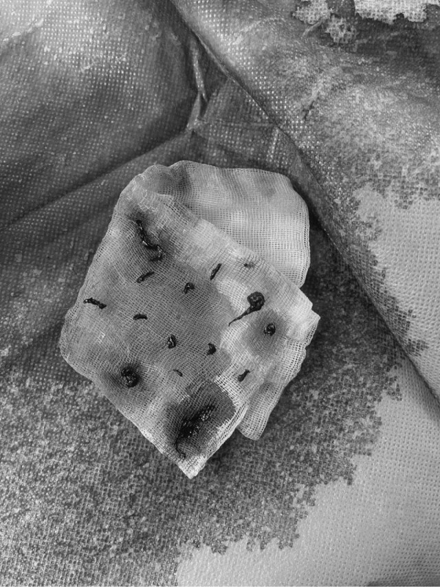 Врачи из Орехово-Зуева спасли пациента, удалив из его головного мозга 14 тромбов