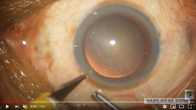 Что ищут офтальмологи у пациентов с катарактой?