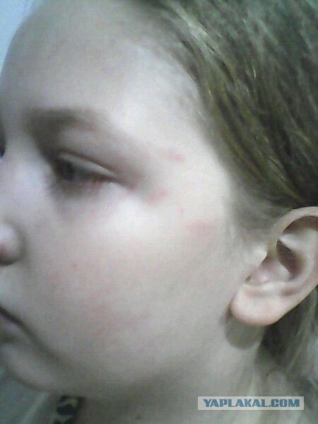 Избита девочка , 10 лет