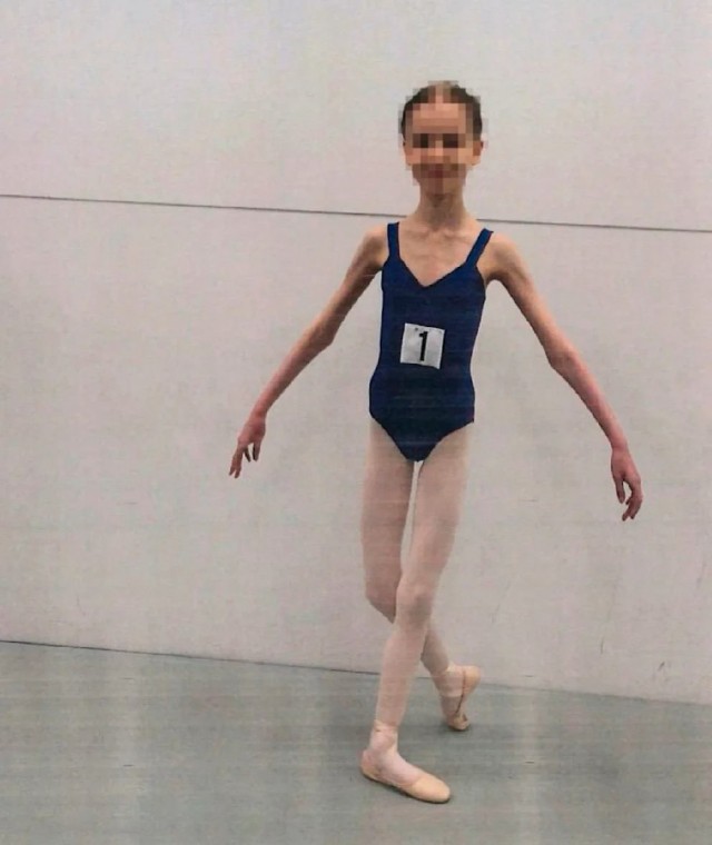 В Австралии родители довели дочь-балерину до истощения — 17-летняя девочка весила 27 килограмм