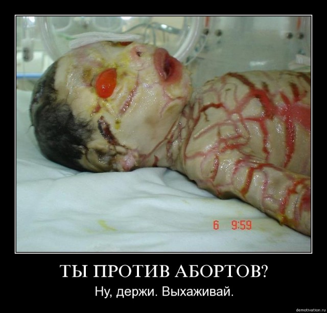 В Исландии все меньше детей рождается с синдромом Дауна