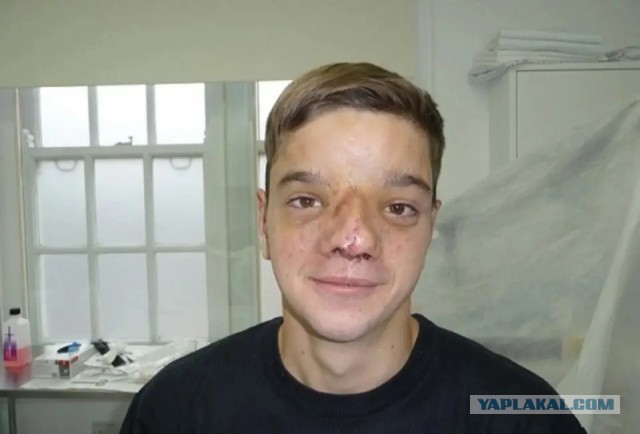 Британский солдат собрал деньги на операцию для мальчика из Боснии, который родился с редким дефектом на лице