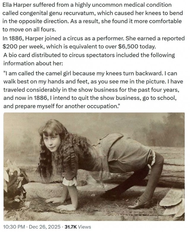 История «Девочки-верблюда».