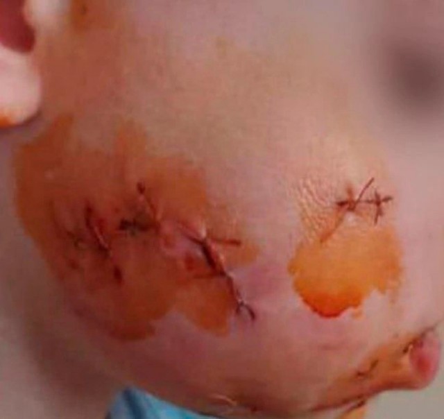 В Приморье бездомная собака напала и изуродовала ребенка, а зоозащитники написали заявление на отца, который спас сына