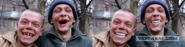 10 знаменитостей до и после реставрации зубов