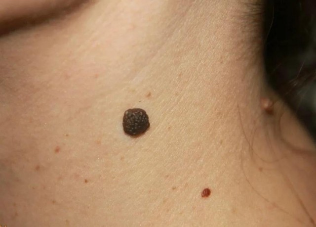 После применения онковакцины