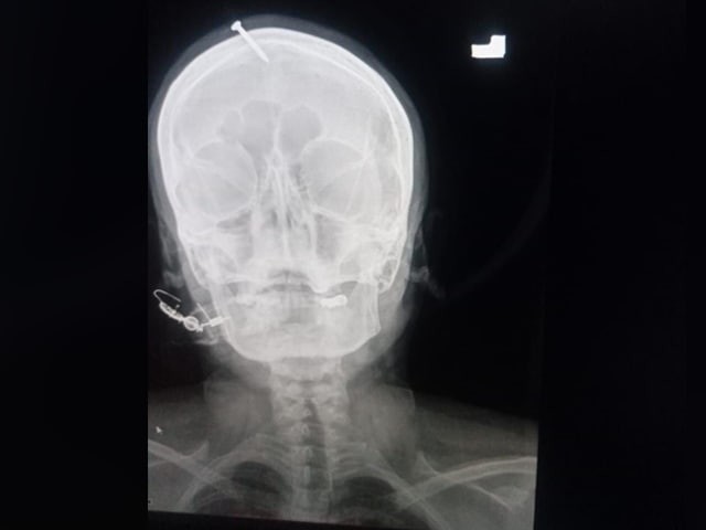 Беременной пакистанке вбили гвоздь в голову, чтобы вместо девочки у неё родился мальчик