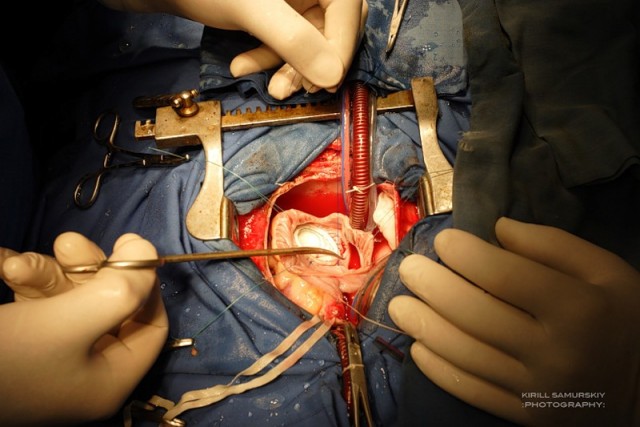 В "гостях" у хирургов: Операция на открытом сердце