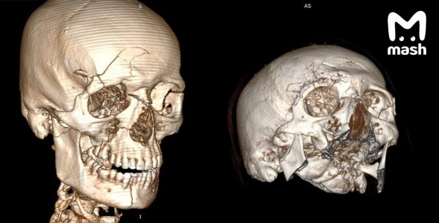 Электросамокатчик раскроил череп после неудачного падения со своего двухколёсного коня.