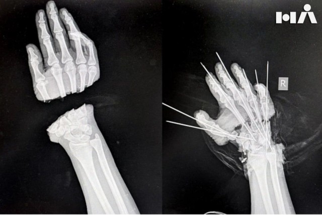 Специалисты из Вредена спасли отсечённую руку девушке