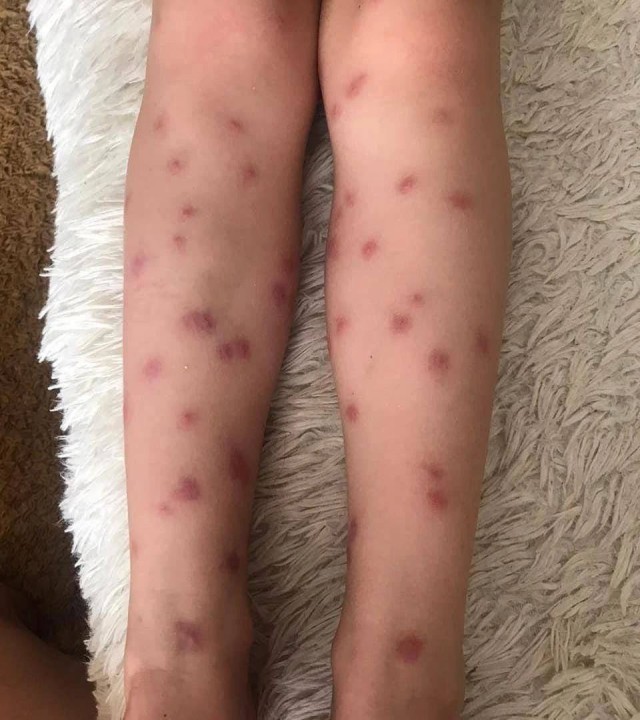 В Московской области зафиксированы случаи церкариоза после купания в открытых водоемах.