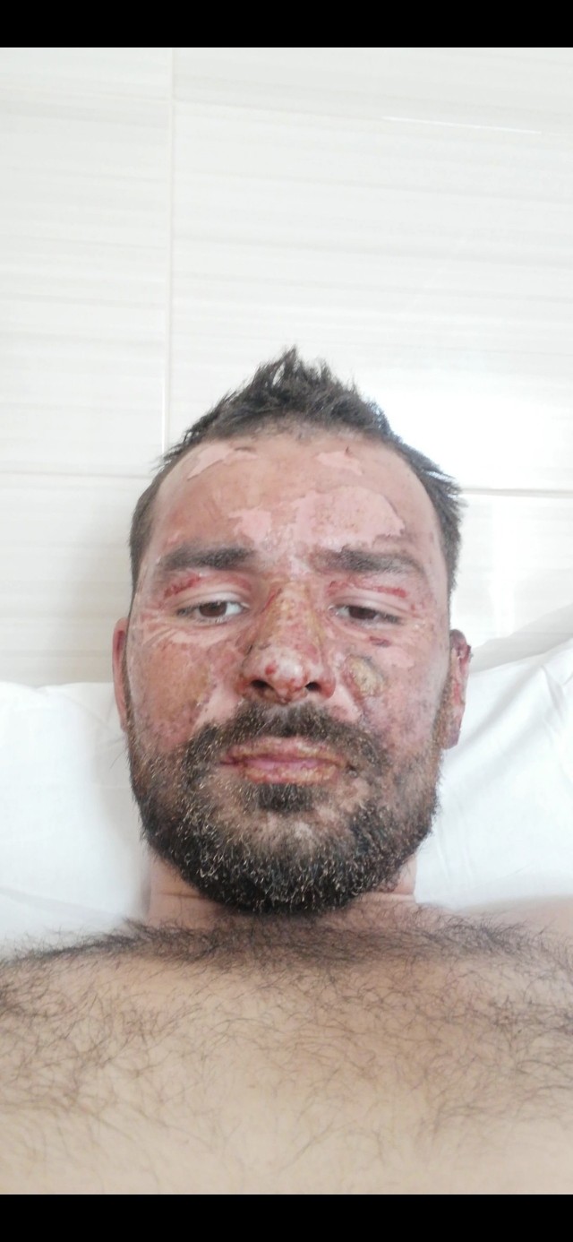 Мужчина спалил лицо, пытаясь повторить модный тренд из Сети на свой день рождения