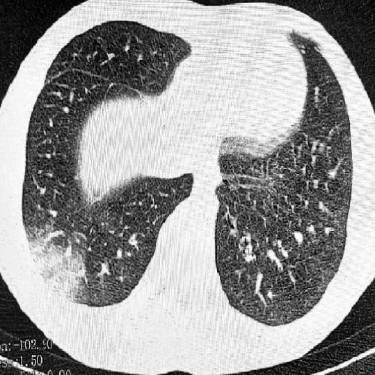 В России впервые выявили "попкорновую болезнь", которая грозит всем вейперам
