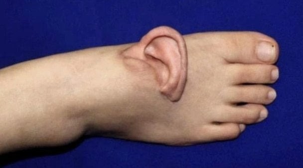 Китаянке пришили оторванное ухо на стопу