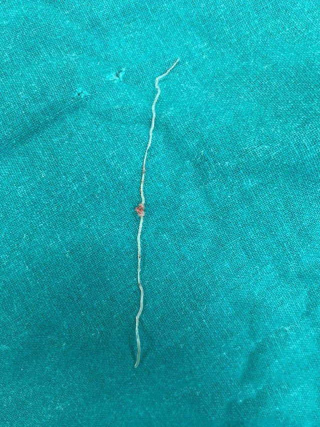 Этого 12-сантиметрового гельминта вытащили из щеки жительницы Люберец