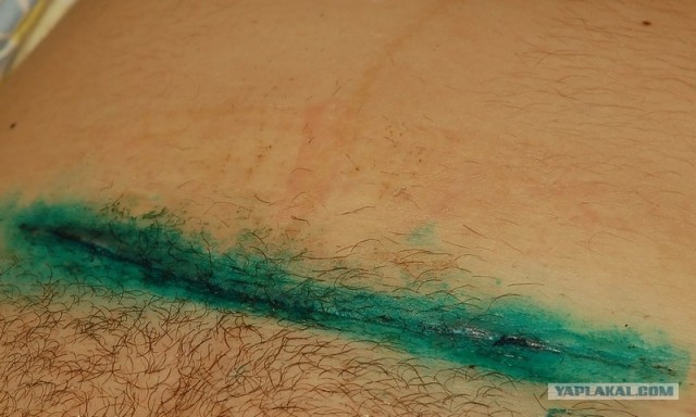 Начало новой жизни:Кесарево сечение своими глазами