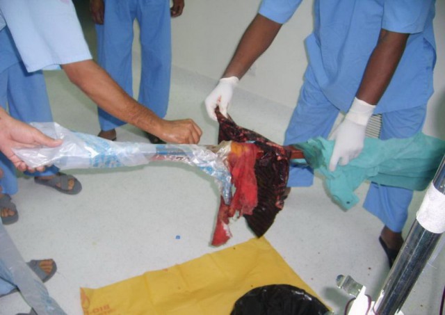 Португальский парень чудом выжил, после того как его проткнуло железякой