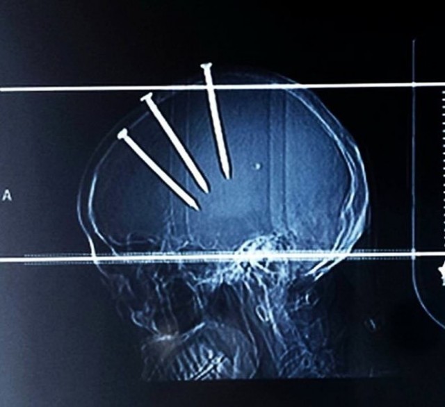 Что вы знаете о хронической мигрени.