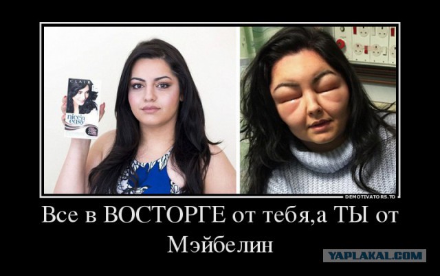 Девушка превратилась в урода из-за аллергиии
