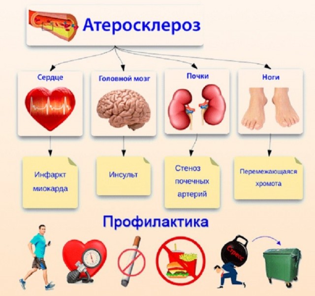 За жизнь до инфаркта