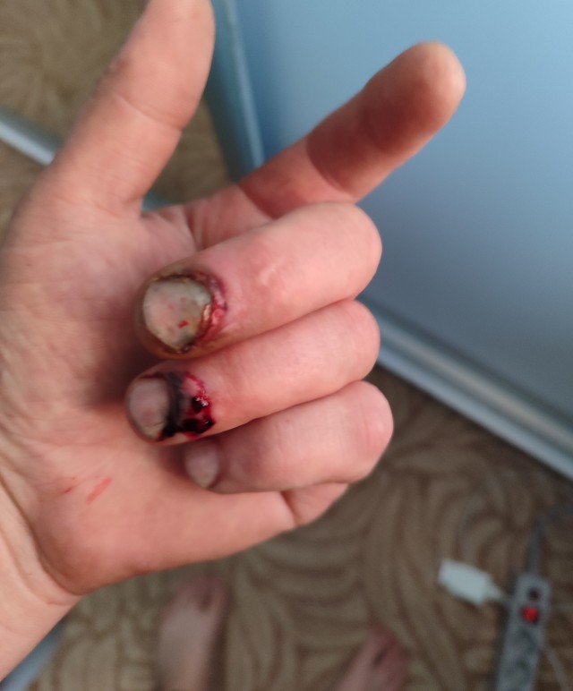 Из жизни одного пальчика