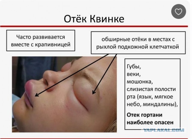 Сильный отёк головы из-за солнца случился у жителя Новосибирска после прогулки на сапе
