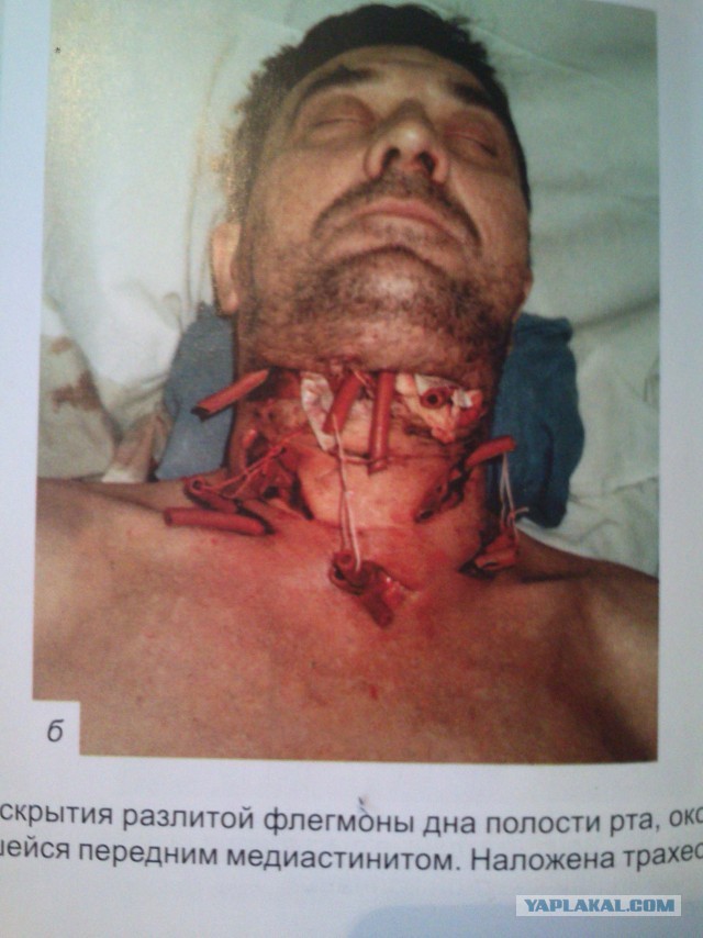 «Я пережил пытки в реанимации и остался инвалидом»