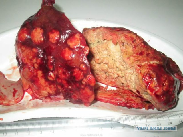 Красноярские хирурги достали из печени мужчины огромного червя