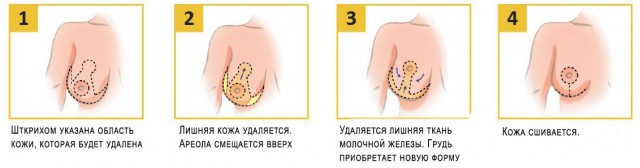 Личный опыт со сделанной грудью