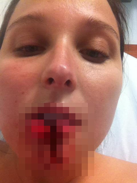 После укуса собаки за лицо и через 10 дней