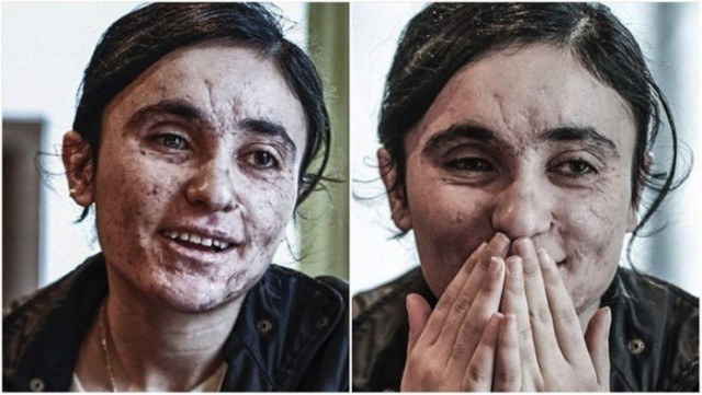 Несломленная: она два года была рабыней джихадистов, а убегая от них, наступила на мину…