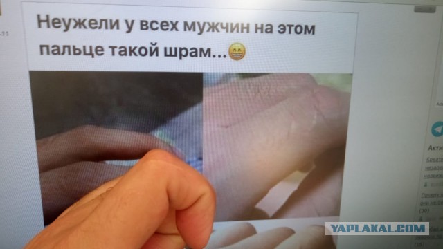 Шрамы на пальце - есть у всех? У меня даже два!