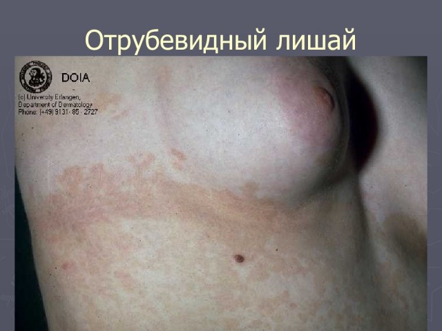 Как лечить бородавки лопухом и прочие байки от дерматолога
