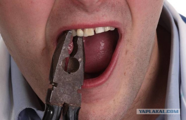 Жители Карелии массово вырывают себе зубы из-за отсутствия денег на стоматолога