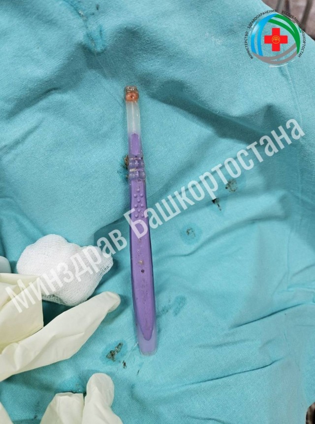 Зубную щётку достали уфимские врачи из пищевода мужчины
