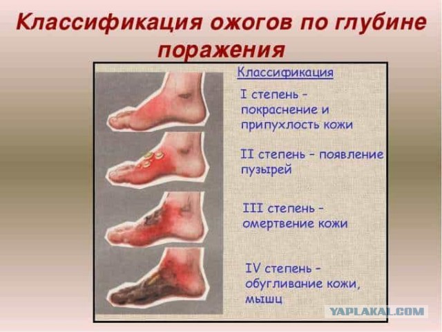 Вредная первая помощь или готовимся к шашлыкам...