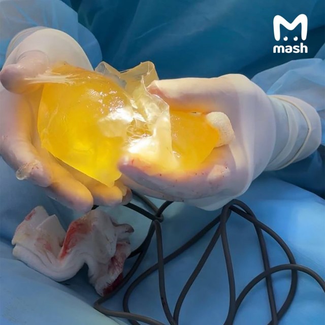 Силиконовая грудь взорвалась у блогерки из Уфы во время тренировки в зале