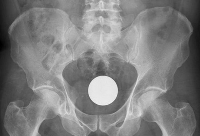 Самые неожиданные вещи, найденные в теле человека