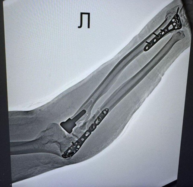 В подмосковной больнице сразу двум пациентам восстановили функцию локтя с помощью эндопротезов