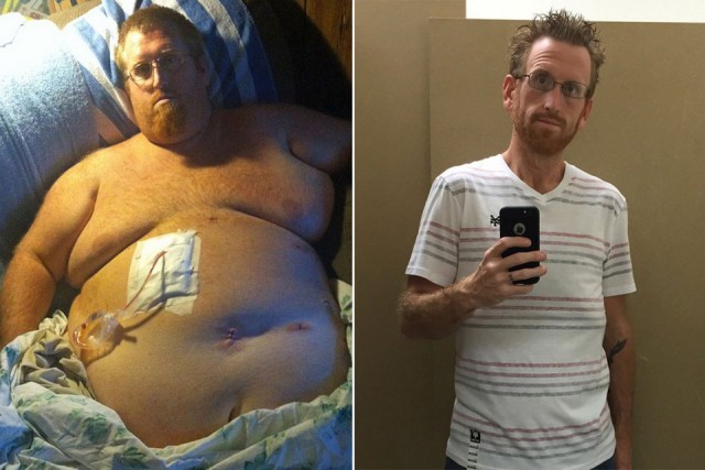 Чтобы не умереть от лишнего веса, американец скинул 160 кг
