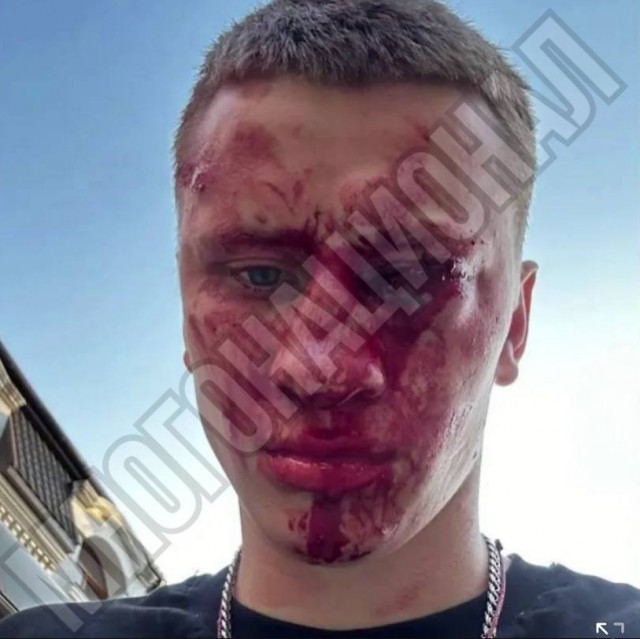 Чемпион России и Европы по боксу Дмитрий Двали лишился глаза, заступившись за мальчика, которого избивала толпа мужчин в Феодосии.