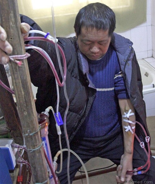 Китаец живет на САМОДЕЛЬНОЙ искусственной почке