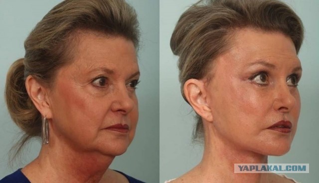 Этапы омоложения лица наглядно.