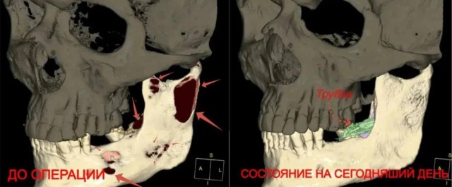 Появившаяся из-за зуба мудрости киста годами растворяла челюсть уральцу