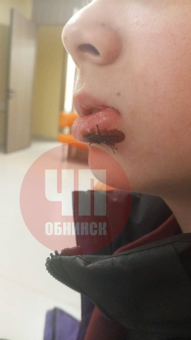 В Обнинске мамаша рассекла парнишке губу, бросив в него каким-то предметом