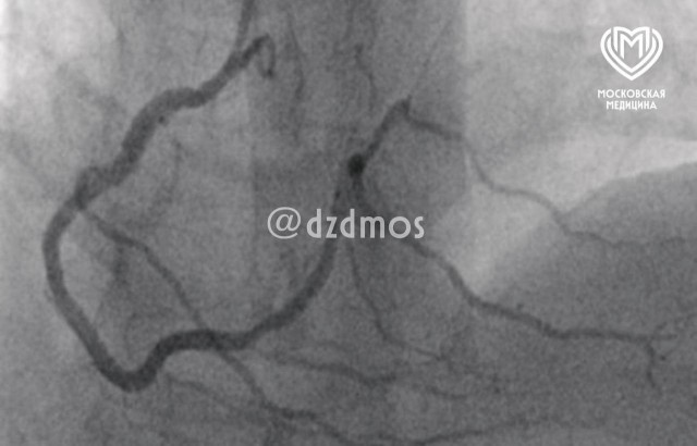 Москвич съел свинину и получил инфаркт