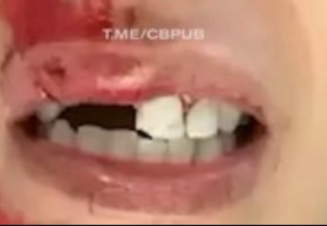 Прыжок закончился походом к дантисту