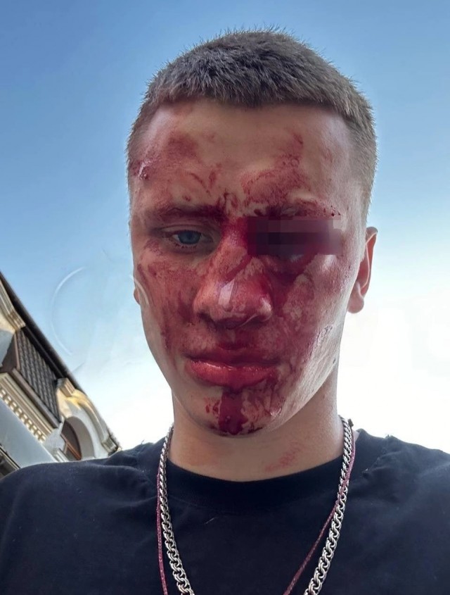 Чемпион России и Европы по боксу Дмитрий Двали лишился глаза, заступившись за мальчика, которого избивала толпа мужчин в Феодосии.